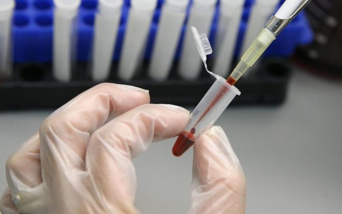 नेपालमा ३४ हजारमध्ये ८ हजार एचआईभी सङ्क्रमित उपचार बाहिर